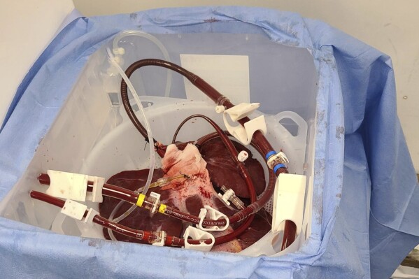 This photo provided by eGenesis on Jan. 18, 2024 shows a genetically modified pig liver in Massachusetts before transportation to the University of Pennsylvania in Philadelphia in December 2023. (eGenesis via AP)